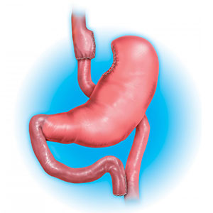 gastric-bypass